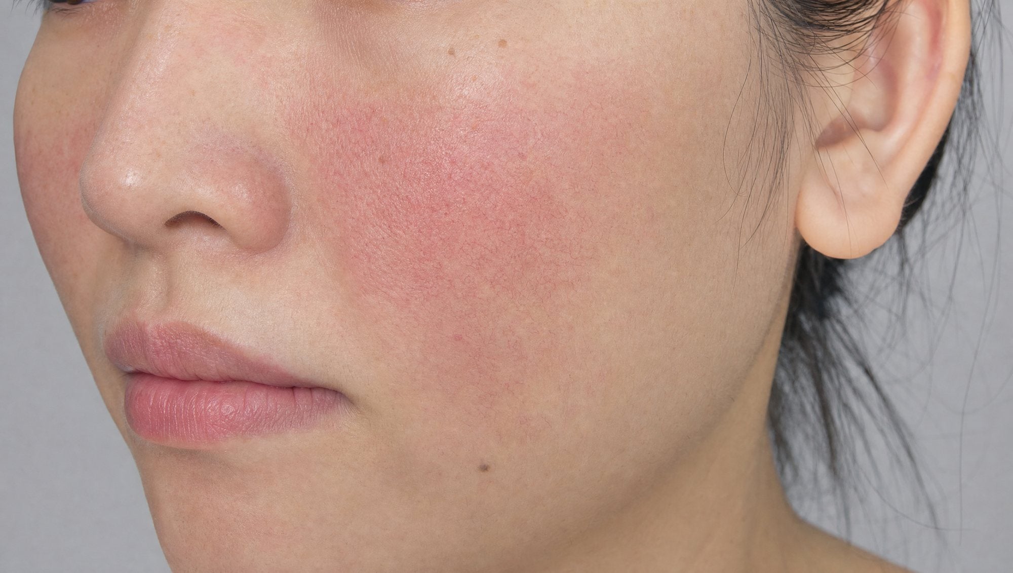 Sensitive skin that flushes easily