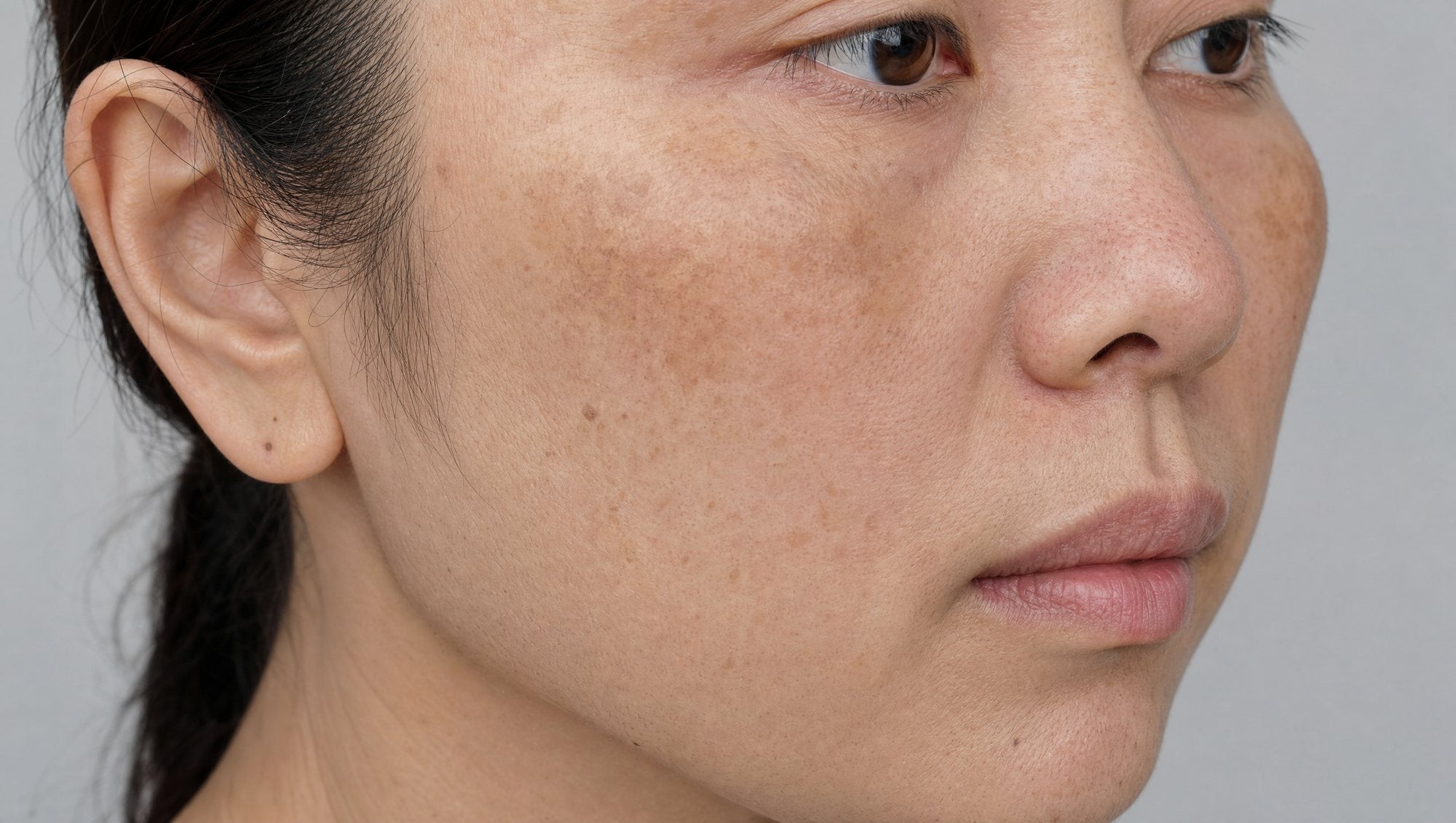 Dull skin with an uneven tone
