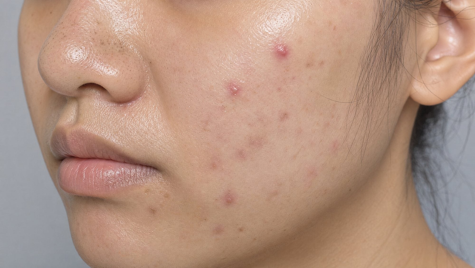 Recurring blemishes and excess oil