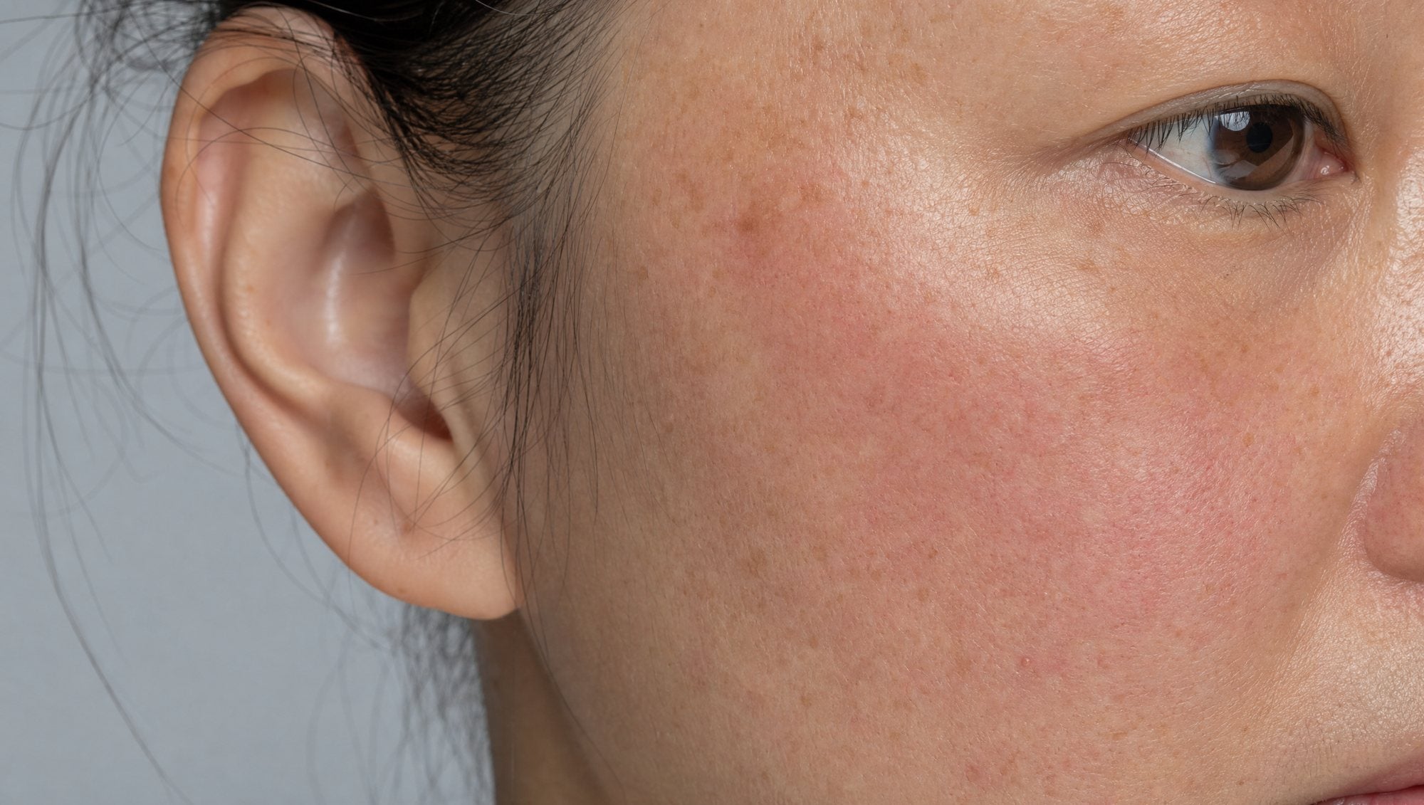 Skin exposed to UV and ambient heat